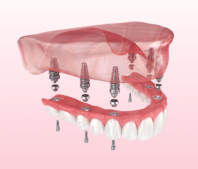 All-on-4 All-on-6 implant tedavileri