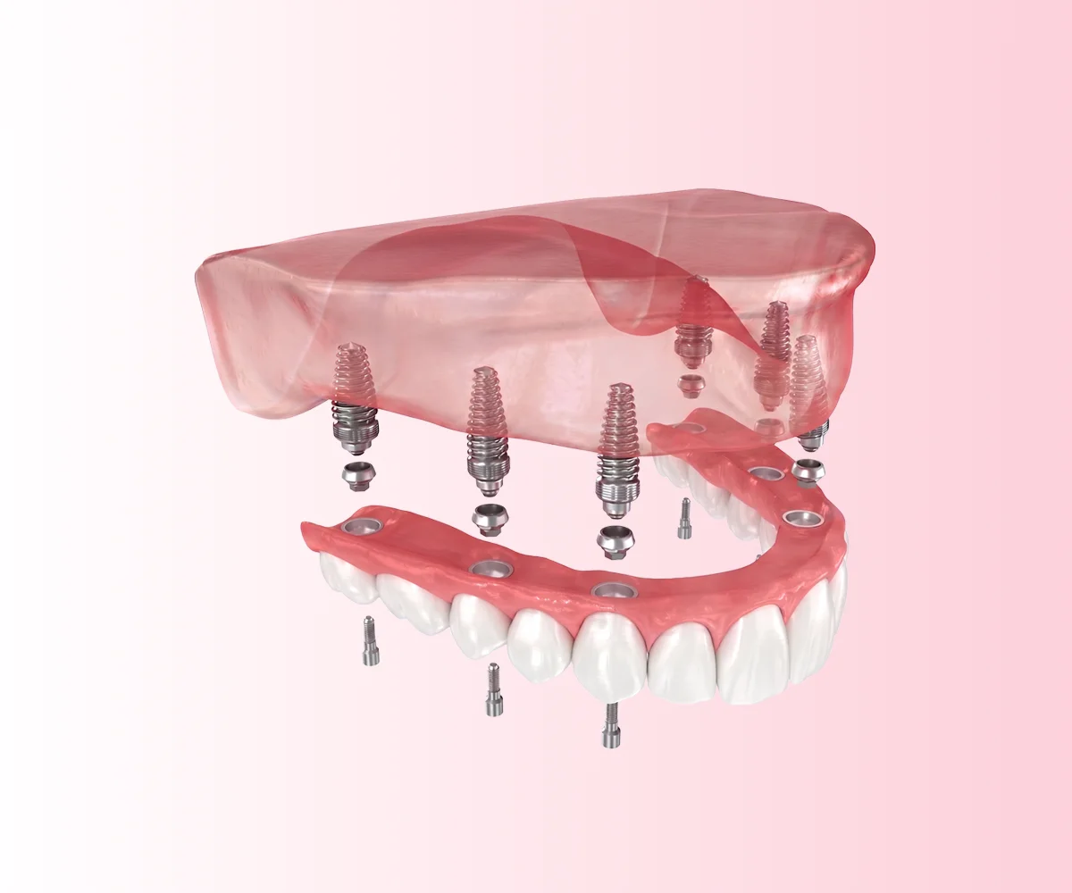 All-on-4 ve All-on-6 implant tedavileri istanbul