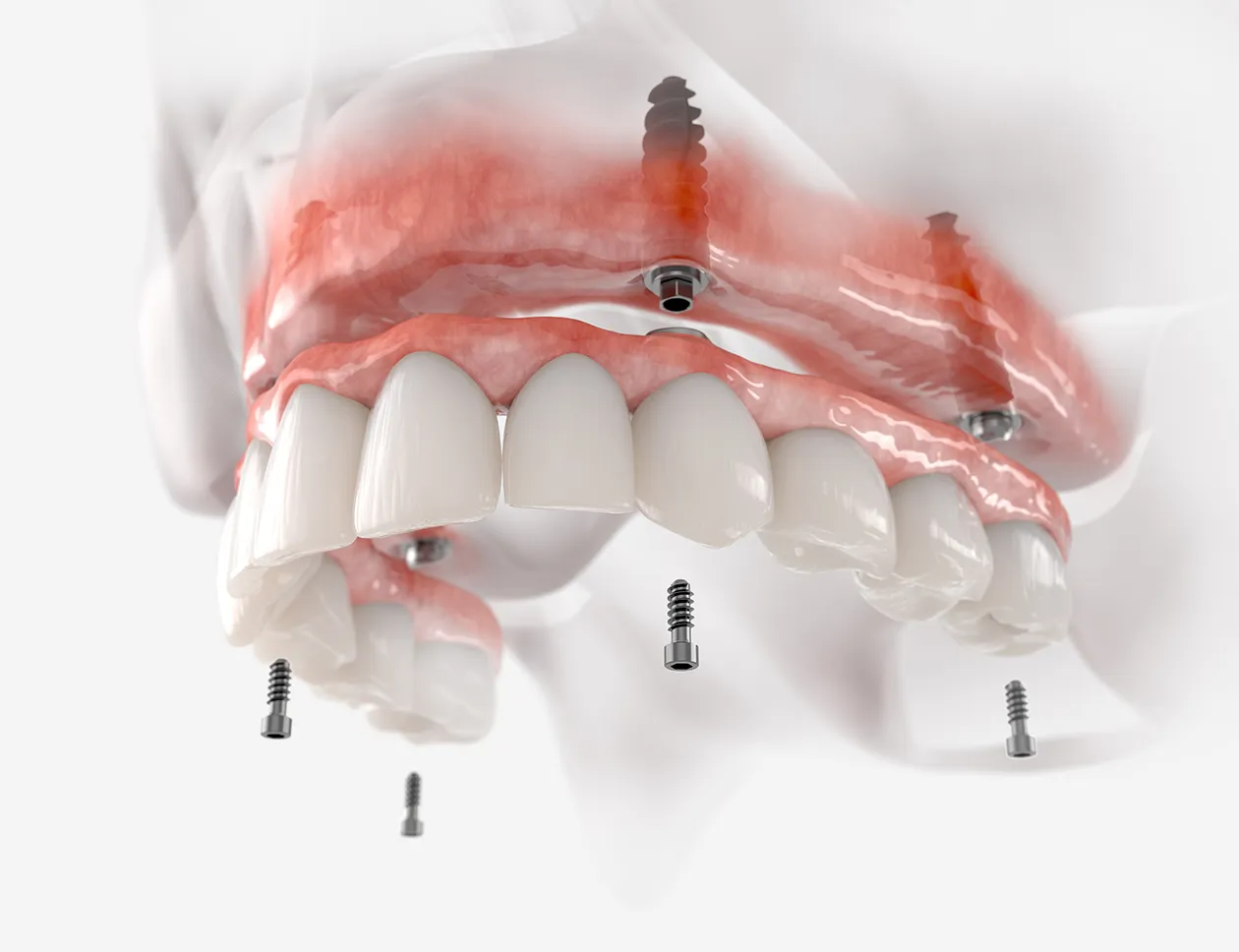 All-on-4 implant tedavisinde dört implantın çene kemiğindeki konumlandırılması