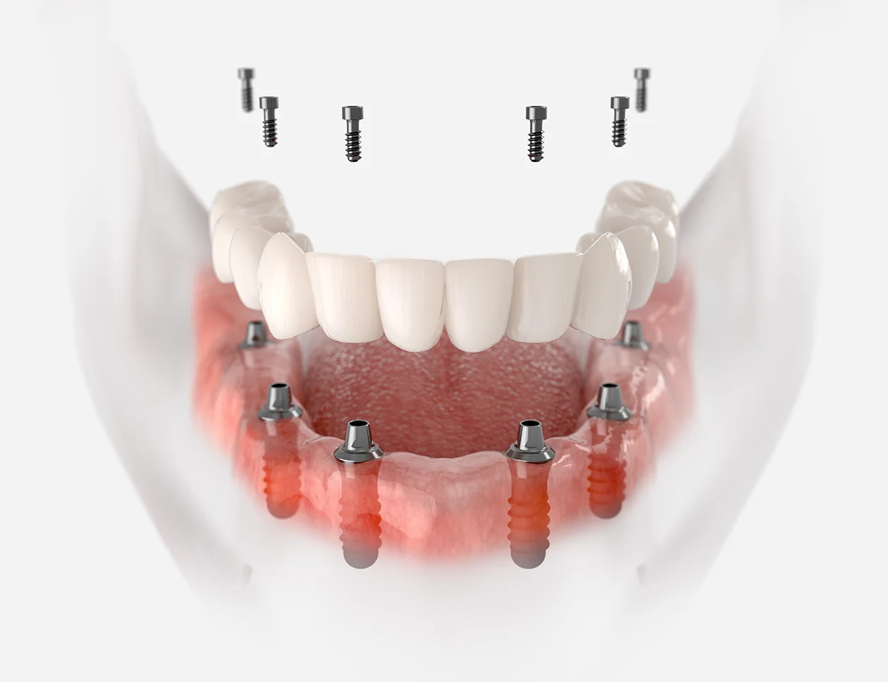 All-on-6 implant tedavisinde altı implantın çene kemiğindeki konumlandırılması