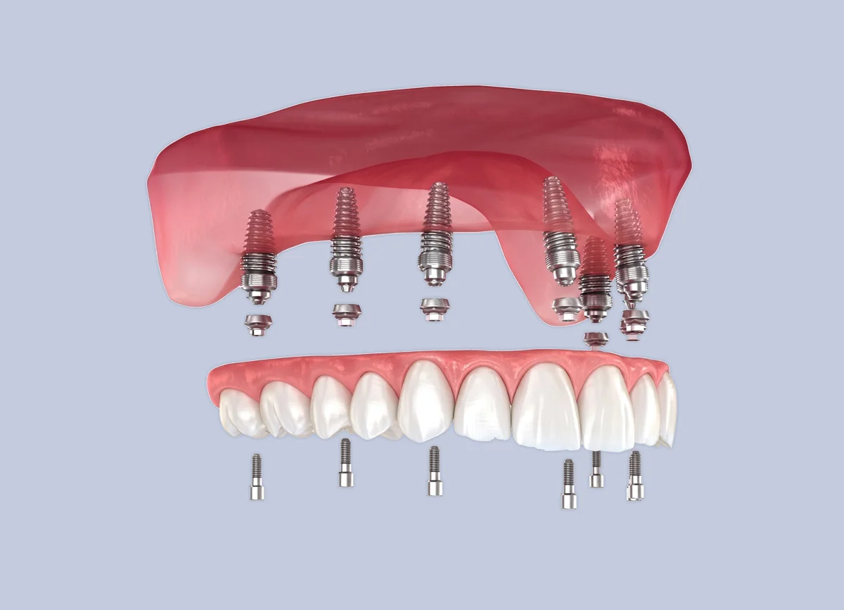 All-on-4 ve All-on-6 tam çene implant tedavisi