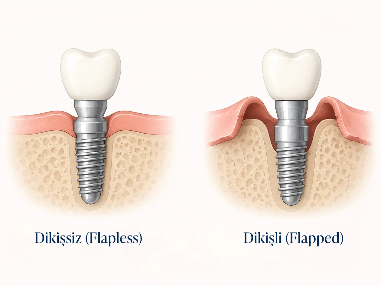 Dikişsiz ve geleneksel implant cerrahisinin karşılaştırılması